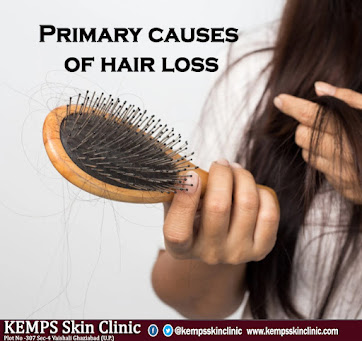 Primary causes of hair loss – Kemps Skin Clinic