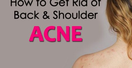 How to get rid of Back & Shoulder Acne