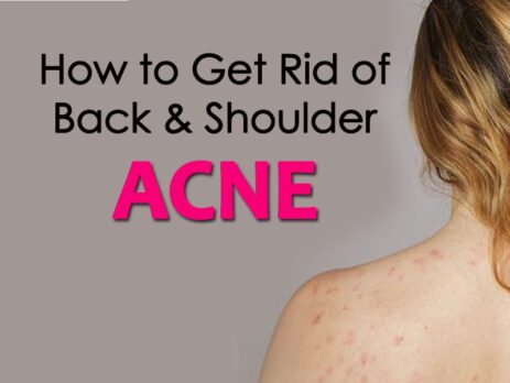 How to get rid of Back & Shoulder Acne