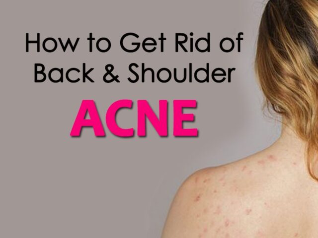 How to get rid of Back & Shoulder Acne