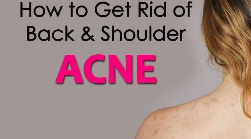 How to get rid of Back & Shoulder Acne