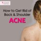 How to get rid of Back & Shoulder Acne